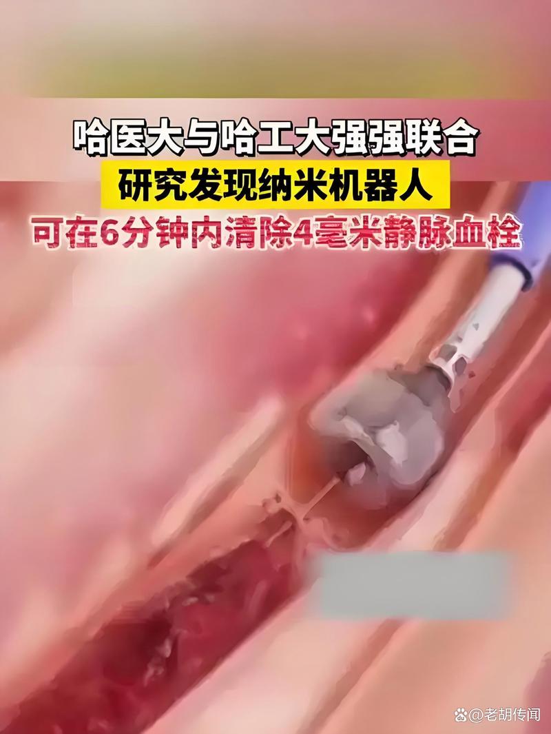 纳米机器人清除血栓实录(纳米机器人清理血管手术多少钱)